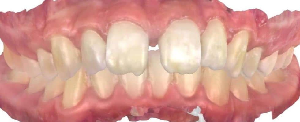 Smile gallery 144 C. S. Front teeth view center before treatment