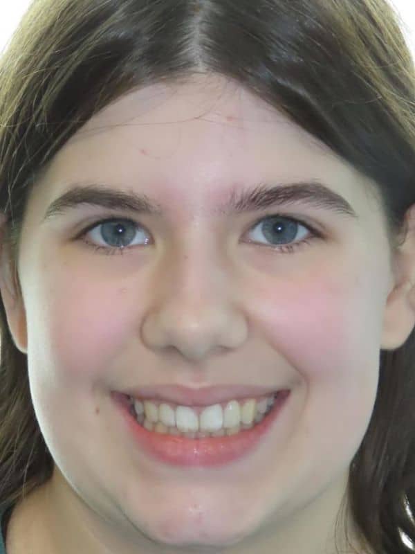 Smile gallery 141 Smile results after treatment
