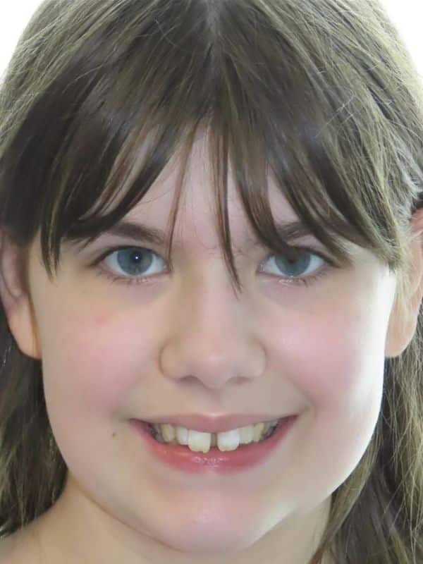 Smile gallery 140 Patient smile before orthodontic treatment