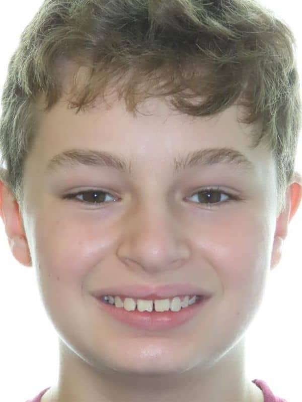 Smile gallery 130 Patient smile before treatment start