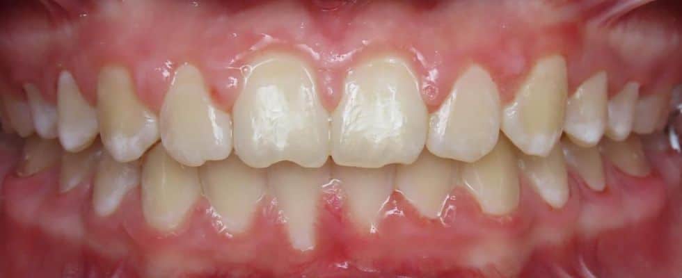Smile gallery 129 Final results center teeth after orthodontic treatment