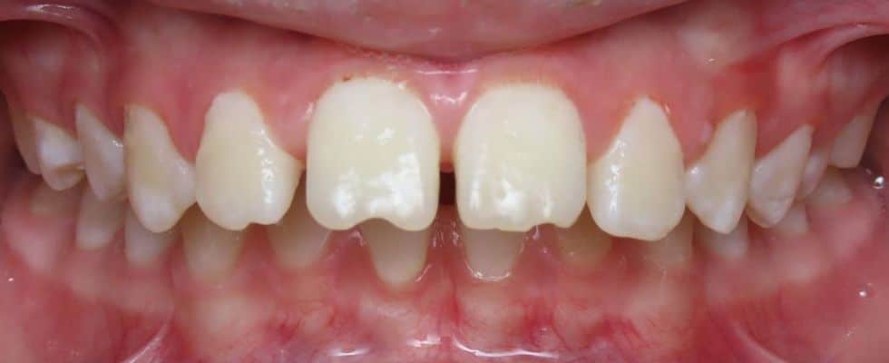 Smile gallery 128 Start center teeth before treatment
