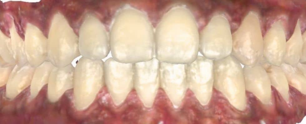 Smile gallery 137 Final results center teeth after orthodontic treatment