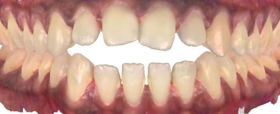 Smile gallery 136 Start center teeth before treatment
