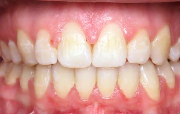 Smile gallery 135 Final results center teeth after orthodontic treatment