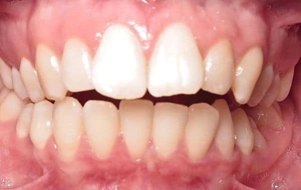 Smile gallery 134 Start center teeth before treatment