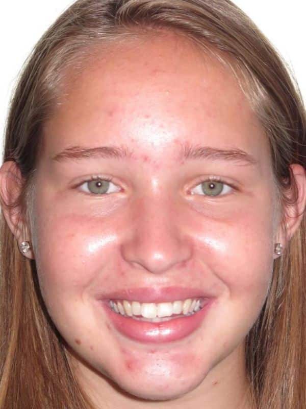 Smile gallery 132 Patient smile before treatment start