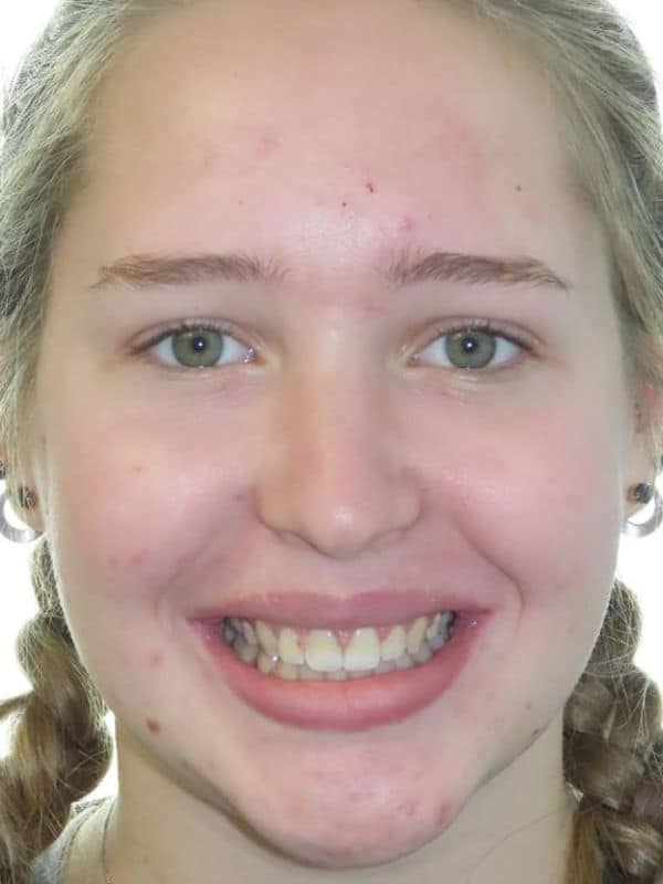 Smile gallery 133 Patient smile final results smiling portrait happy