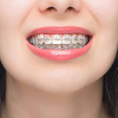 Close up of mouth smiling with braces