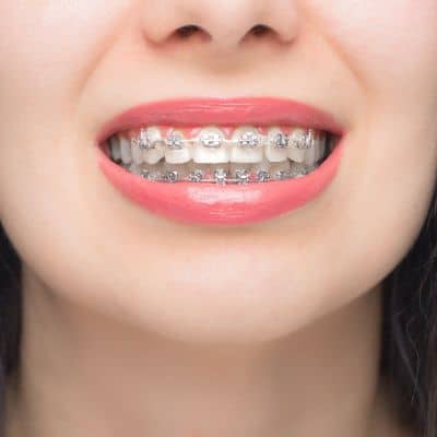 5 quick tips for your first week with braces 9 Close up of mouth smiling with braces