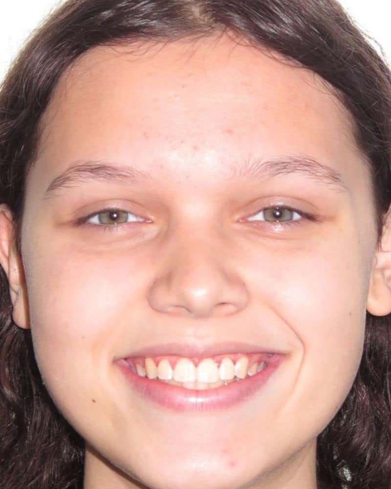 Smile gallery 123 A close up of a woman's face after treatment at jfo