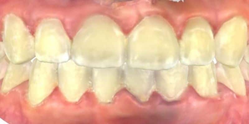 Smile gallery 121 Close-up of a human teeth after treatment with jfo