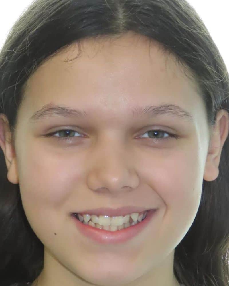 Smile gallery 122 A close up of a girl's face before treatment with jfo