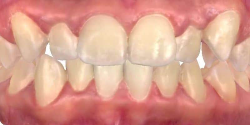 Smile gallery 120 Close-up of teeth and gums before treatment at jfo