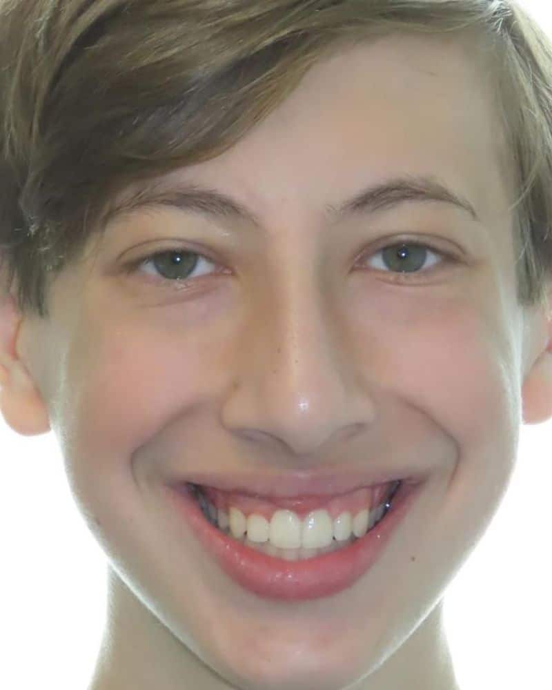Smile gallery 117 A close up of a boy smiling after jfo treatment