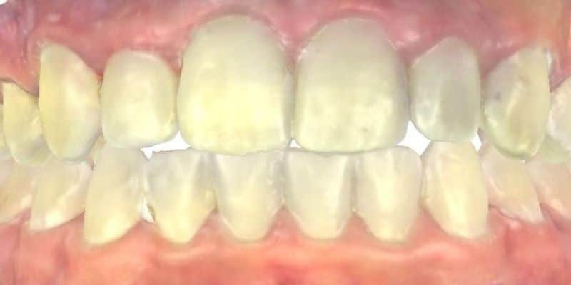Smile gallery 119 Close-up of teeth after joosse family orthodontic treatment
