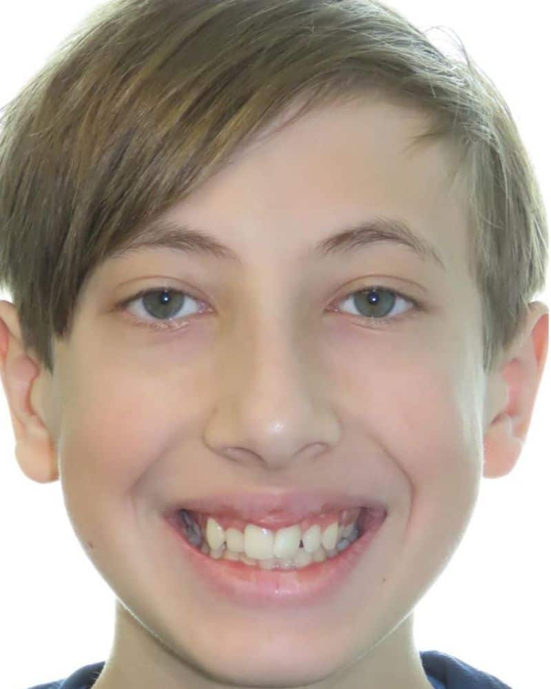 Smile gallery 116 A close up of a boy before jfo treatment
