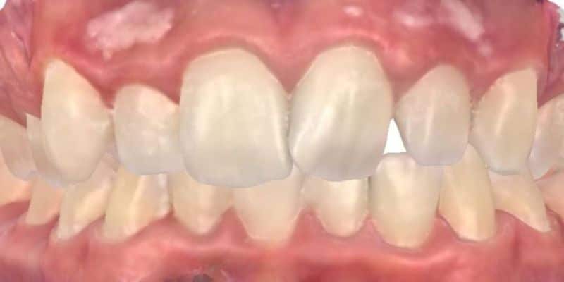 Smile gallery 118 Close-up of teeth before joosse family orthodontic treatment