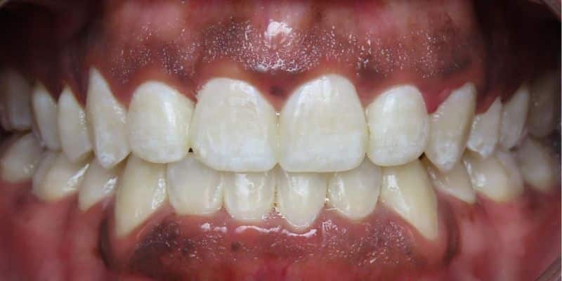 Smile gallery 127 Close-up of a person's mouth after orthodontic treatment