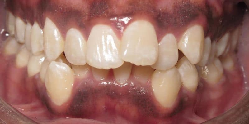 Smile gallery 126 Close-up of teeth and gums before orthodontic treatment