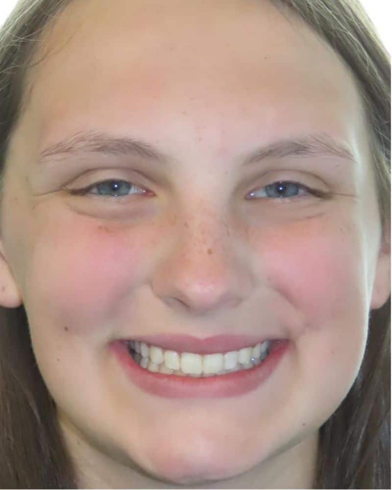 Smile gallery 115 A close up of a woman's face after jfo treatment