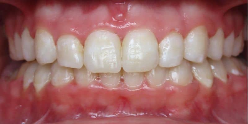 Smile gallery 113 Close-up of teeth and gums after jfo treatment