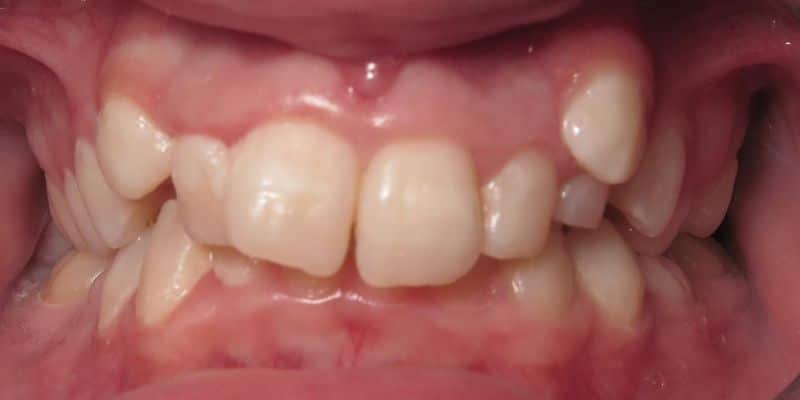 Smile gallery 112 Close-up of a person's teeth before jfo treatment