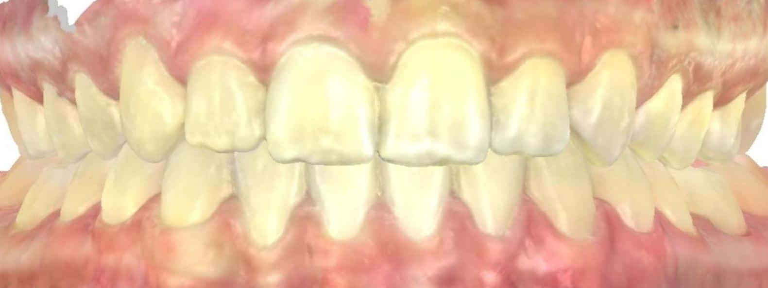 Smile gallery 103 Kirby moore closeup after joosse family orthodontics transformation