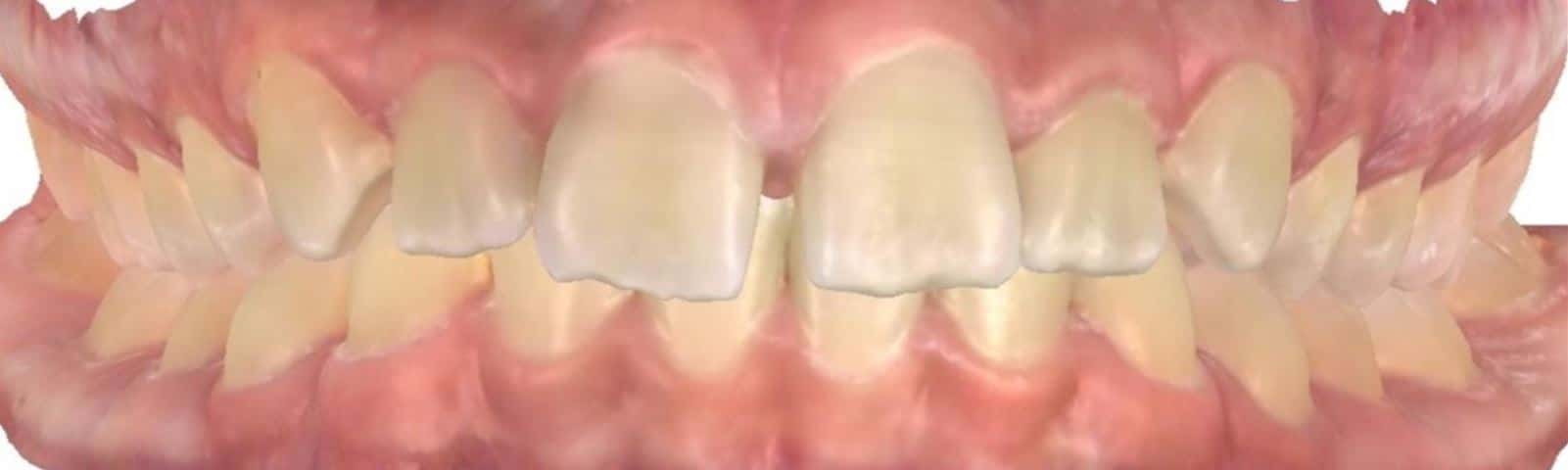 Smile gallery 102 Kirby moore closeup before joosse family orthodontics transformation