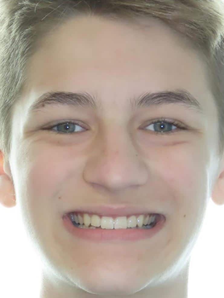 Smile gallery 101 Kirby moore after joosse family orthodontics transformation