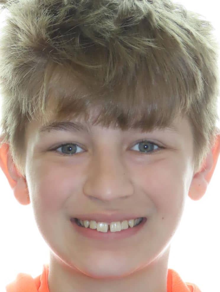 Smile gallery 100 Kirby moore before joosse family orthodontics transformation