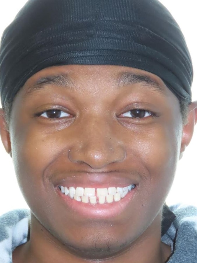 Smile gallery 98 Jfo patient jordan