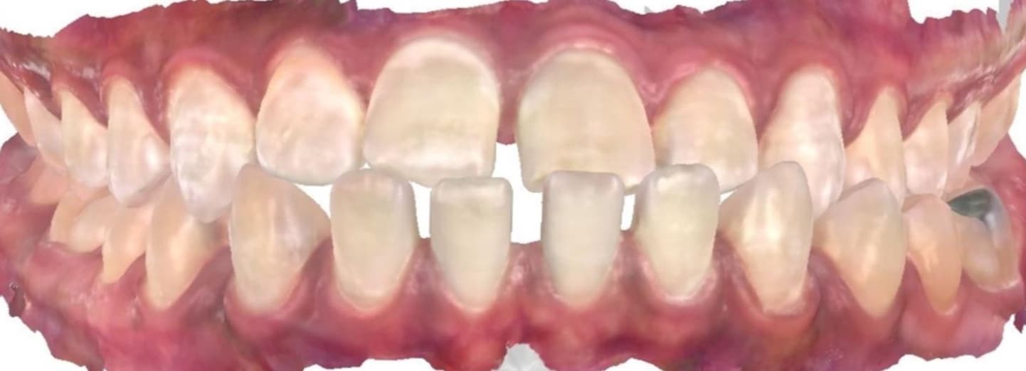 Smile gallery 96 Jordan spratley itero scan before treatment