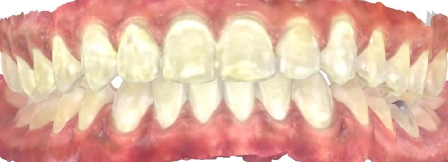 Smile gallery 97 Jordan spratley itero scan after treatment