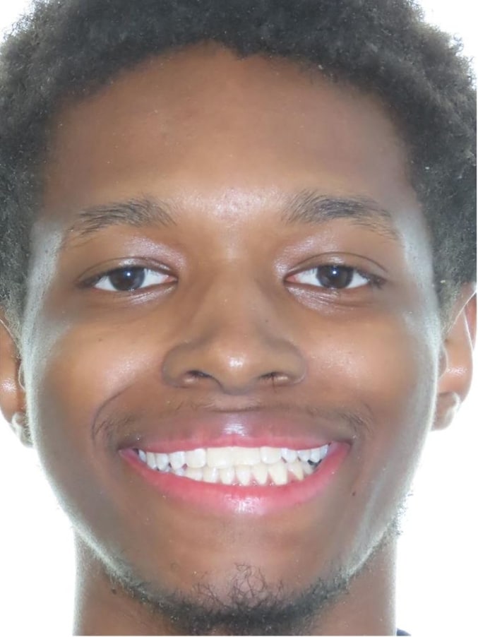 Smile gallery 99 Jordan spratley after treatment