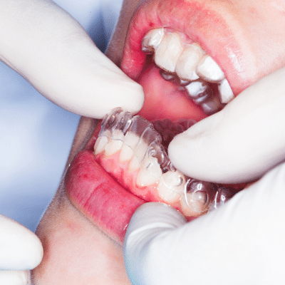 Common orthodontic problems and their solutions 3 Orthodontist putting clear aligners on a patient, representing common orthodontic problems