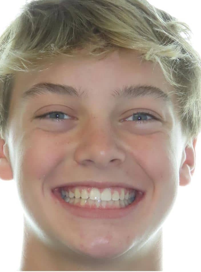 Smile gallery 83 Cole after smile