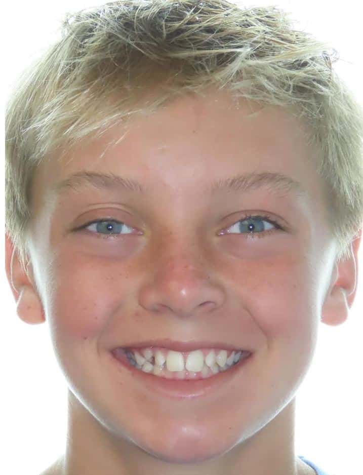 Smile gallery 82 Cole before smile