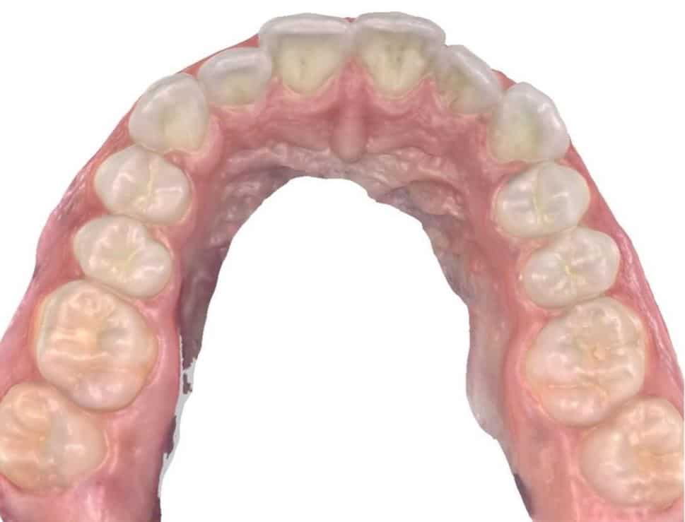 Smile gallery 94 Before top teeth