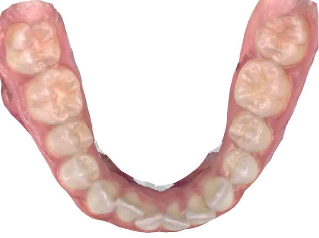 Smile gallery 92 Before bottom teeth