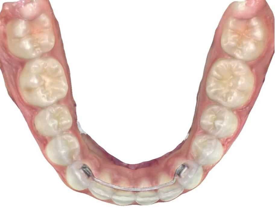 Smile gallery 93 After bottom teeth