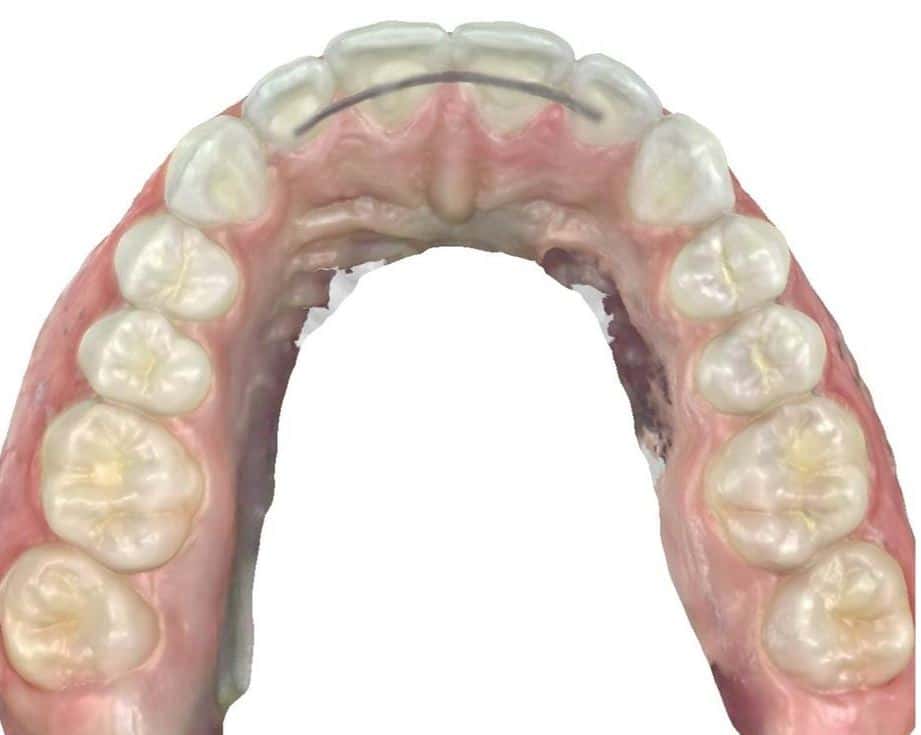 Smile gallery 95 Top teeth after