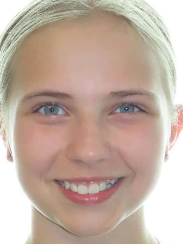 Smile gallery 88 Penelope before smile