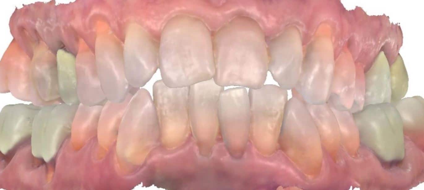 Smile gallery 76 Audrey start teeth front view