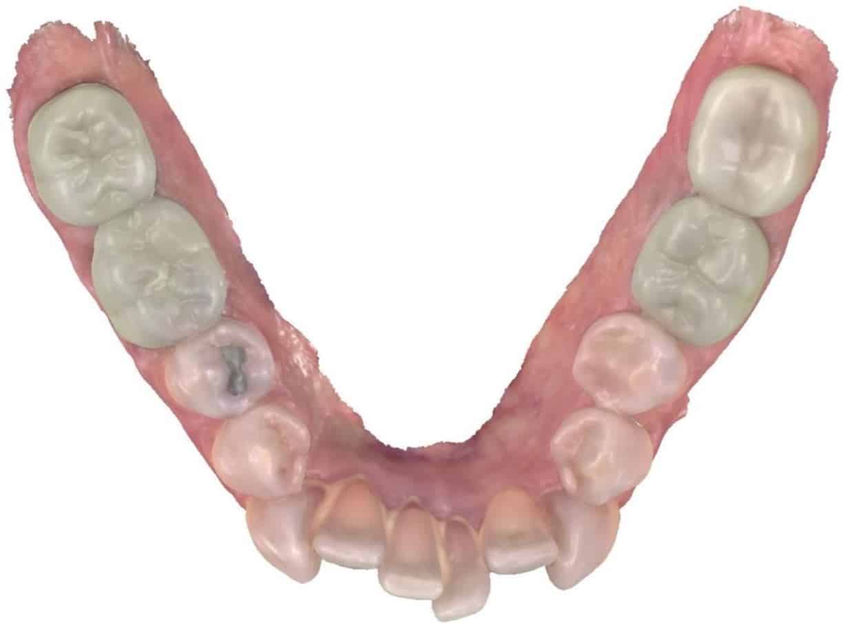 Smile gallery 78 Bottom teeth before