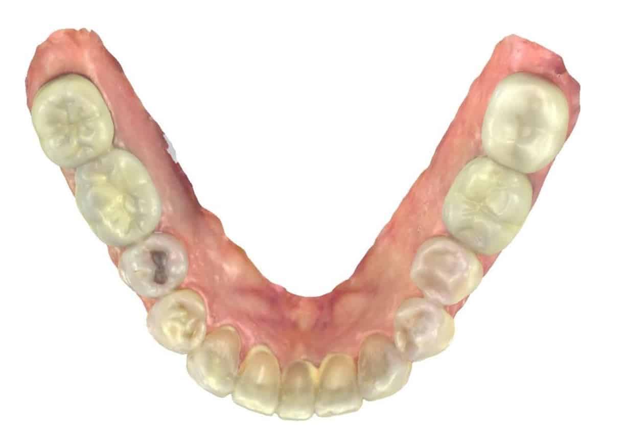 Smile gallery 79 Bottom teeth after