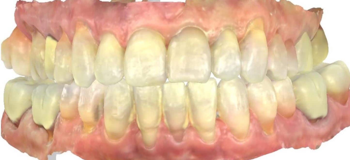 Smile gallery 77 Audrey front teeth after