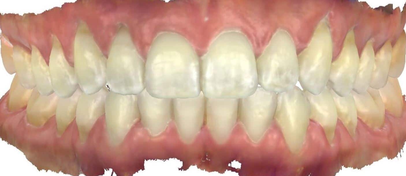 Smile gallery 75 Kelli after teeth