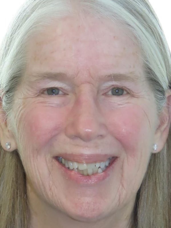Smile gallery 80 Before smile transformation
