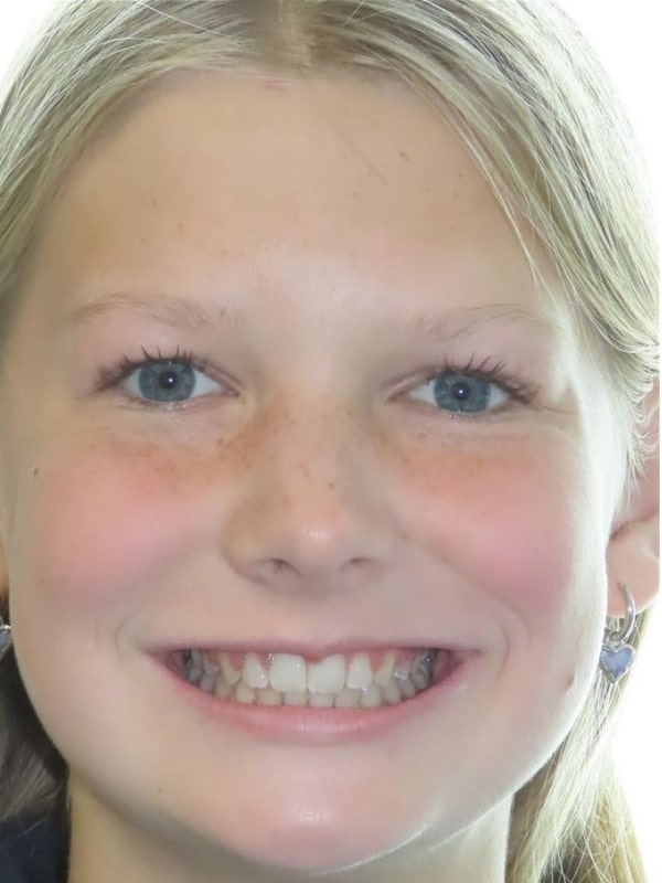 Smile gallery 71 Joosse clare after